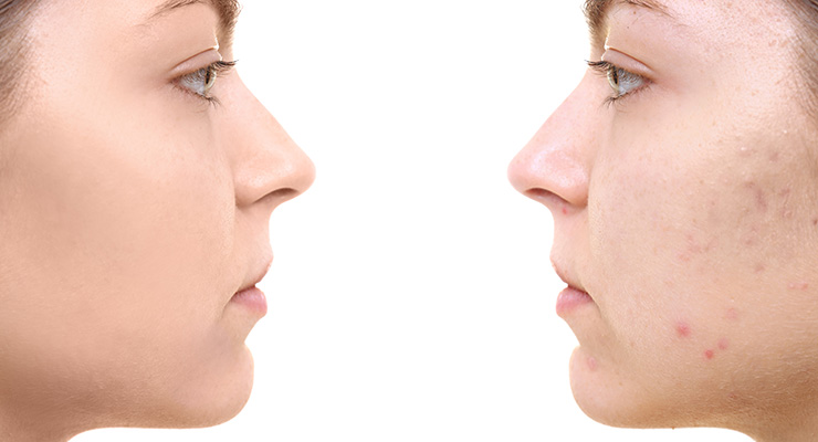 Azelaic Acid Anti-Blemish Purifying Stick