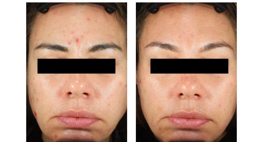 oral glutathione acne clinical trial Injection: Benefits, Safety, & What To Expect Glutathione as a skin whitening